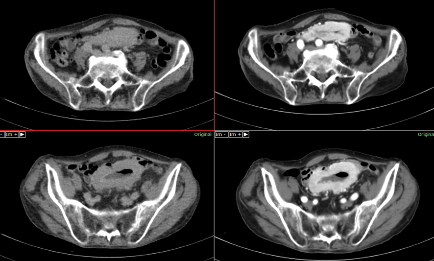 腹部CT-小腸癌
