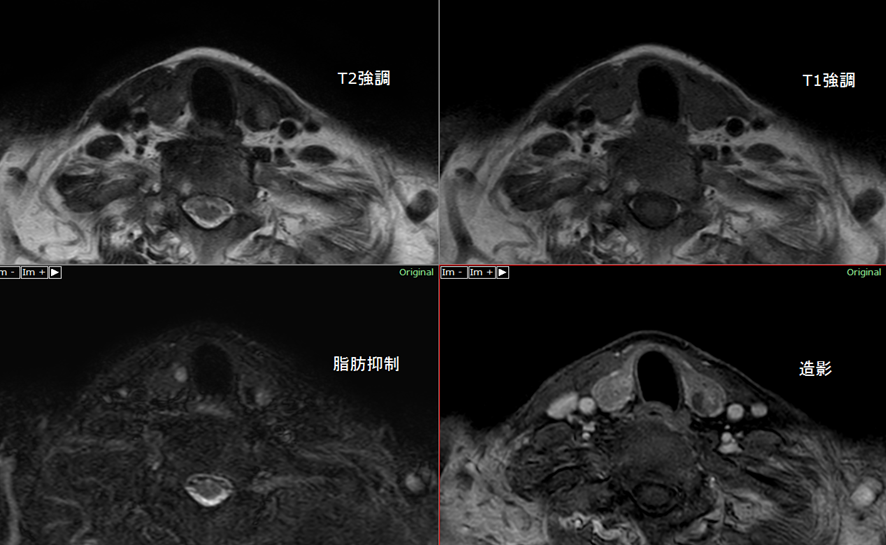 頸部MRI-甲状腺癌