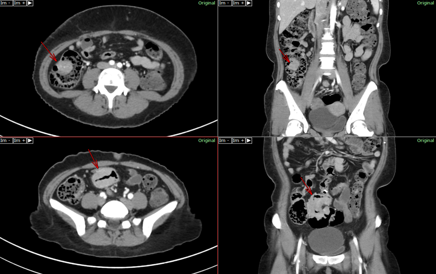 腹部CT-多発大腸癌