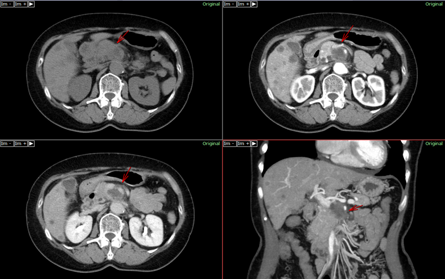 腹部CT-膵臓癌