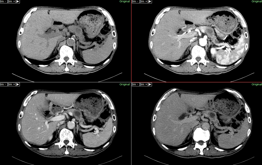 腹部CT-膵体部癌