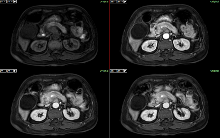 腹部MRI-膵臓癌