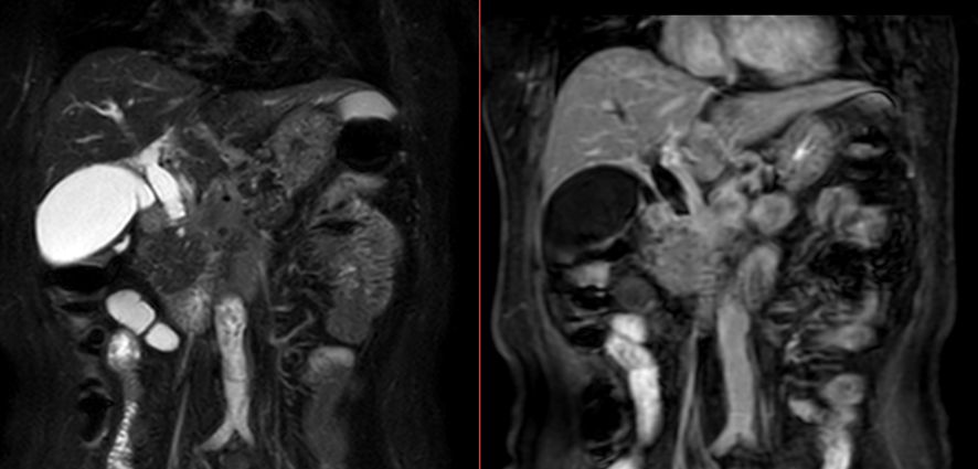 腹部MRI-膵臓癌