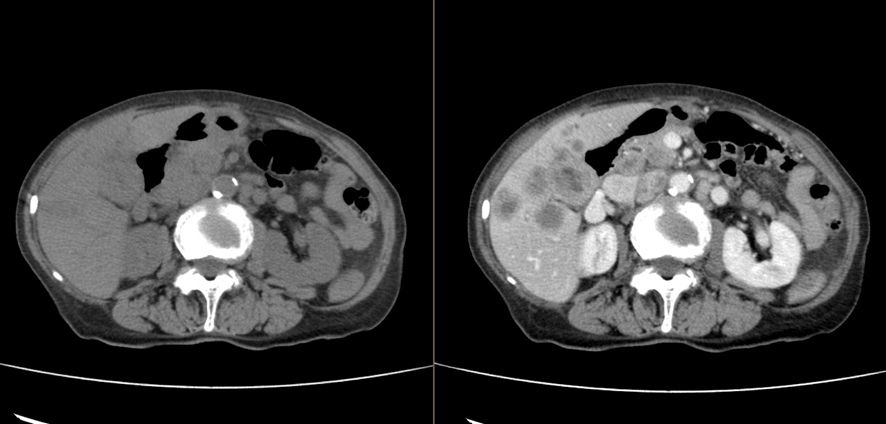 腹部CT-胆嚢癌、肝転移