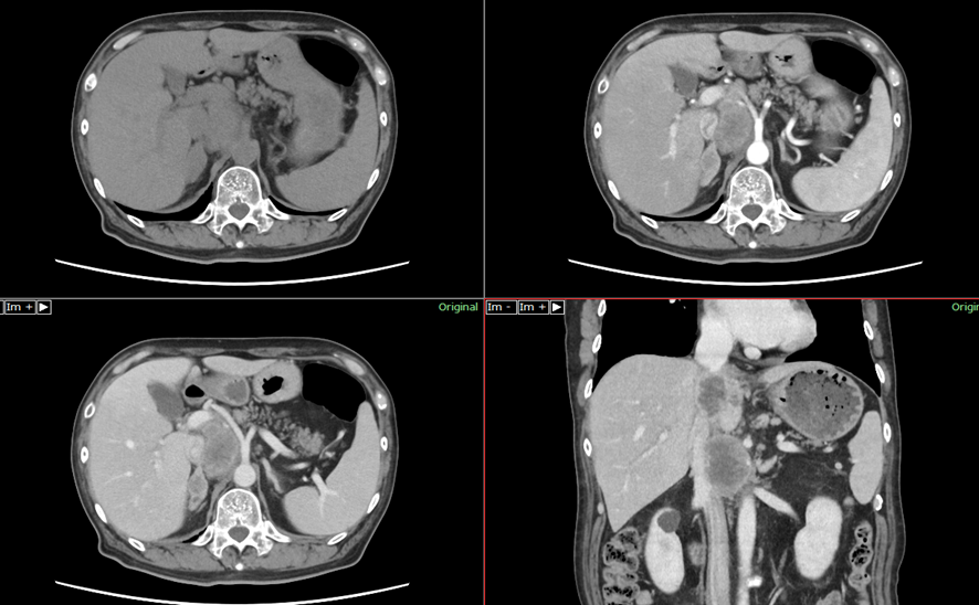 腹部CT-肝門部胆管癌