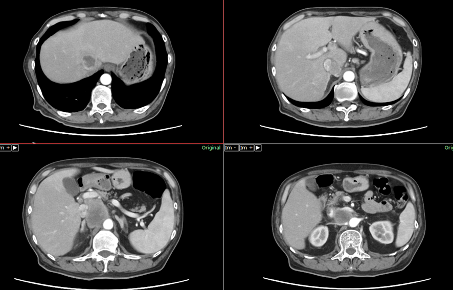 腹部CT-肝門部胆管癌