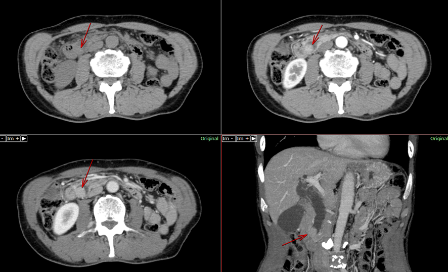 腹部CT-遠位胆管癌