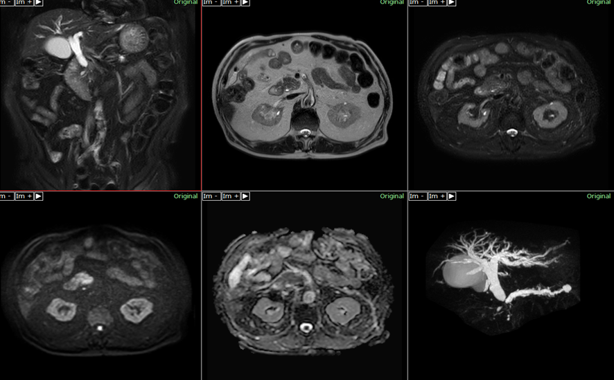 腹部MRI-胆管癌