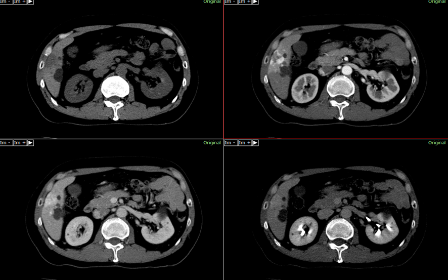 腹部CT-肝細胞癌