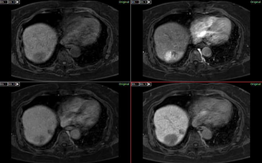 腹部MRI-肝細胞癌