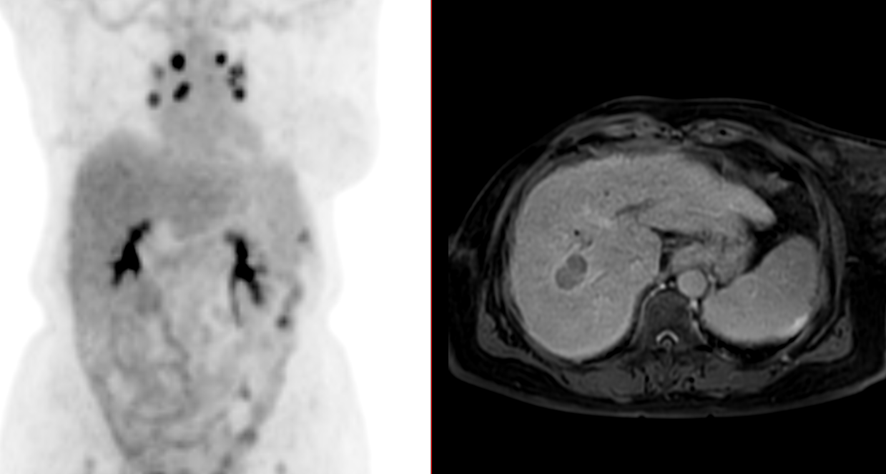 腹部MRIとFDG-PET-肝細胞癌