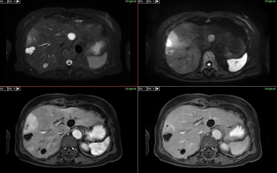 腹部MRI-肝膿瘍