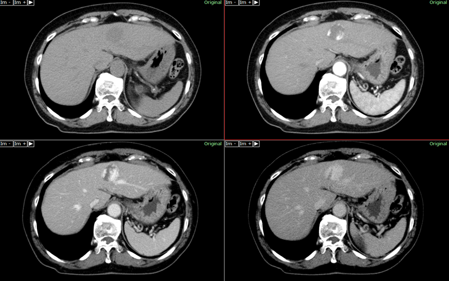 腹部CT-肝血管腫