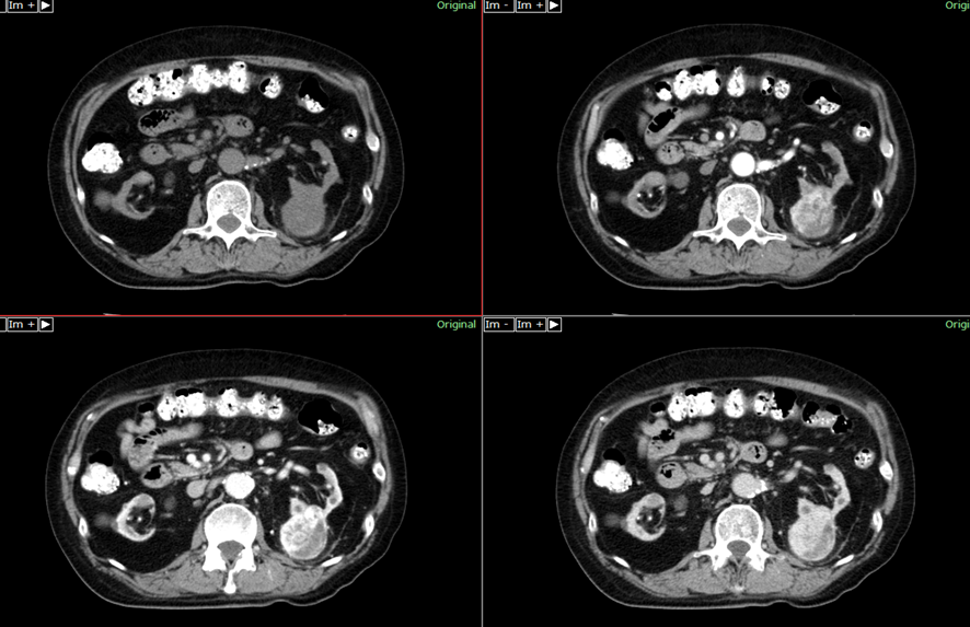 腹部CT-腎細胞癌