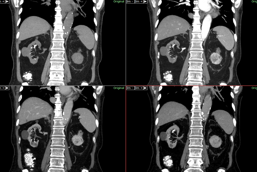 腹部CT-腎細胞癌