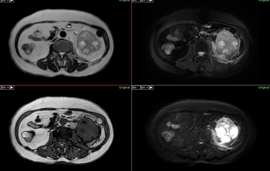 腹部MRI-腎細胞癌
