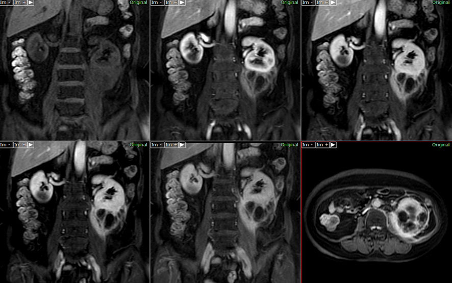 腹部MRI-腎細胞癌
