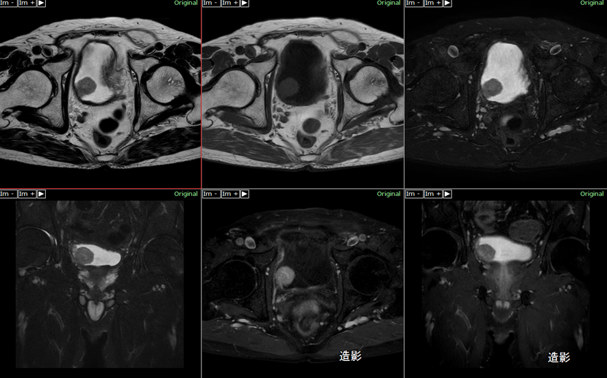 骨盤MRI-膀胱癌