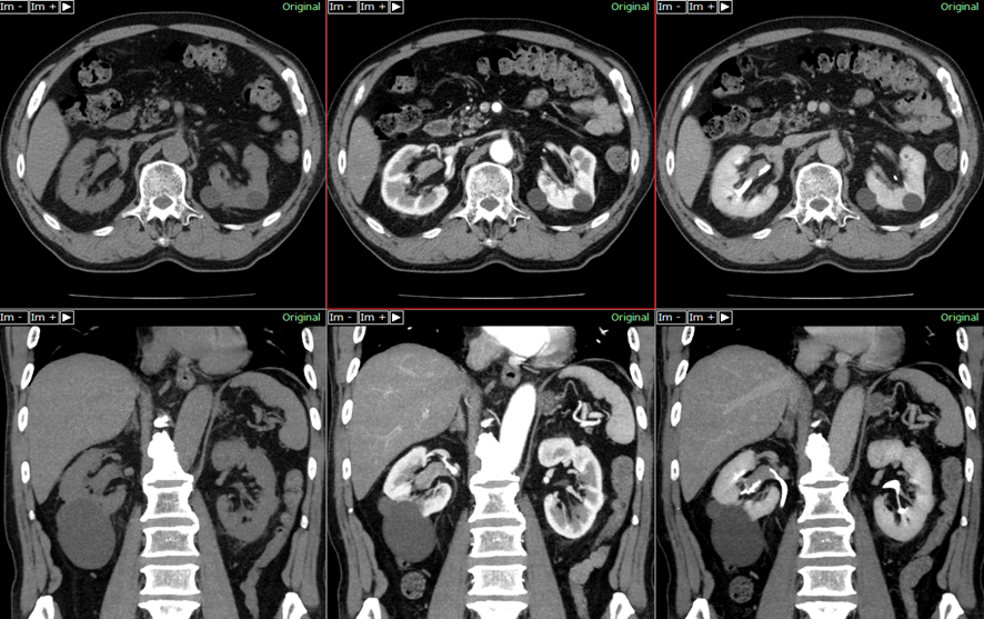 腹部CT-腎盂癌