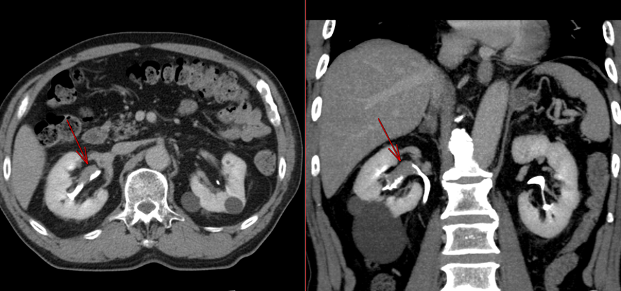 腹部CT-腎盂癌
