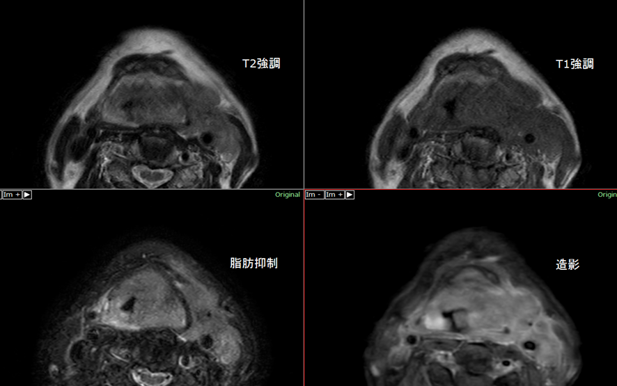 頸部MRI-喉頭癌