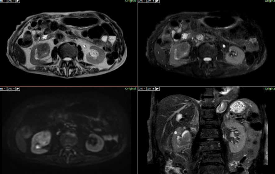 腹部MRI-腎盂癌