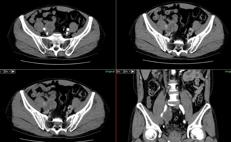 腹部CT-尿管癌