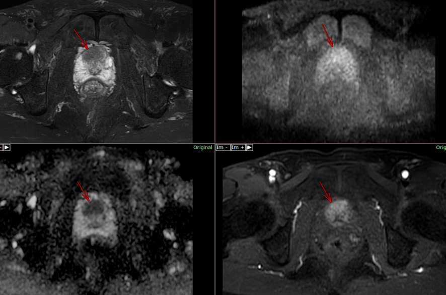 前立腺MRI-前立腺癌