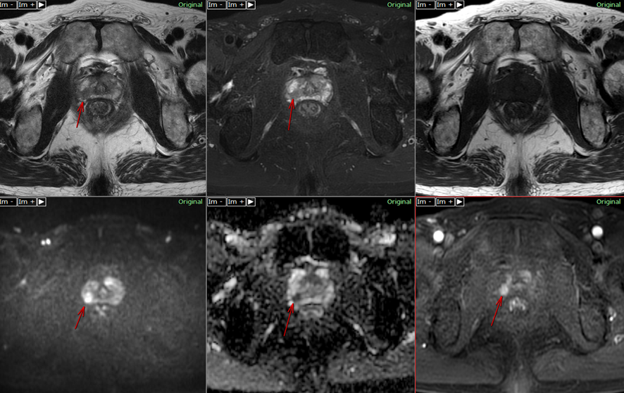 前立腺MRI-前立腺癌