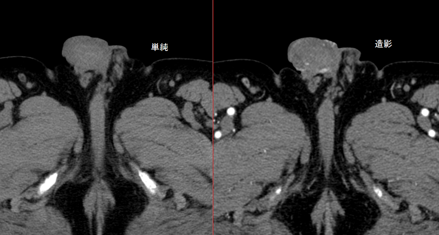 造影CT-陰茎癌