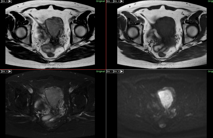 骨盤MRI-子宮体癌