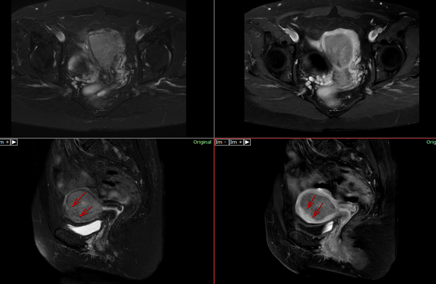 骨盤MRI-子宮体癌（SSE途絶）