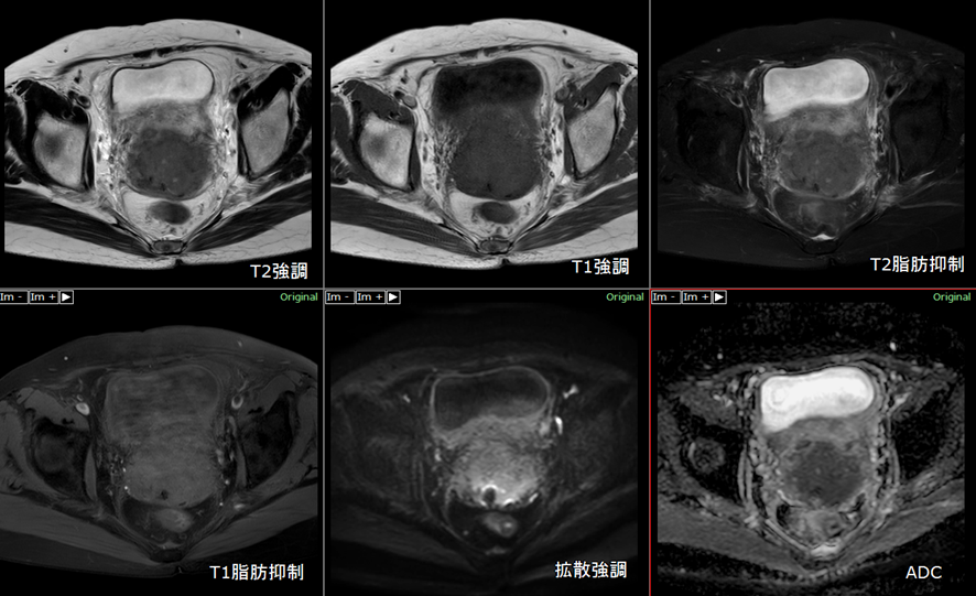 骨盤MRI-子宮体癌（Stage4）