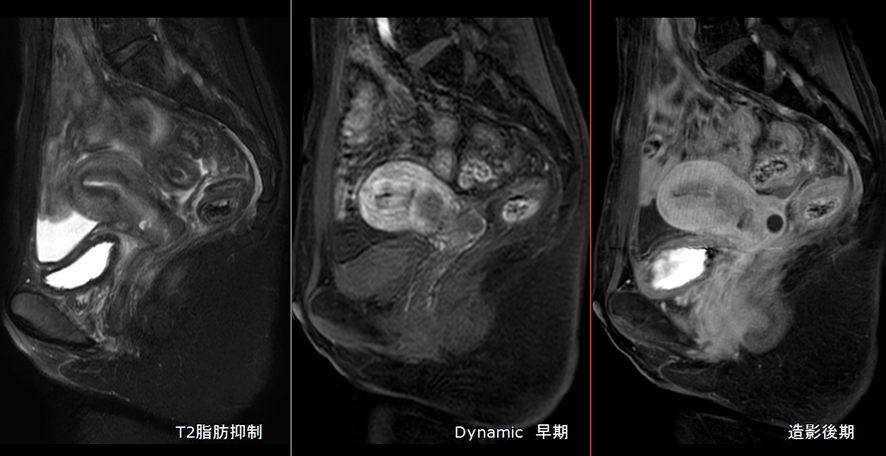 骨盤MRI-子宮頚癌