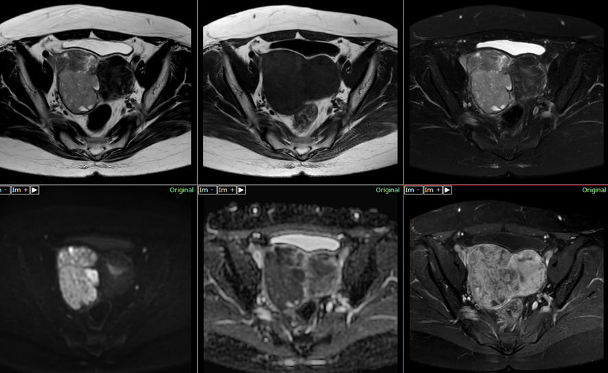 骨盤MRI-平滑筋肉腫