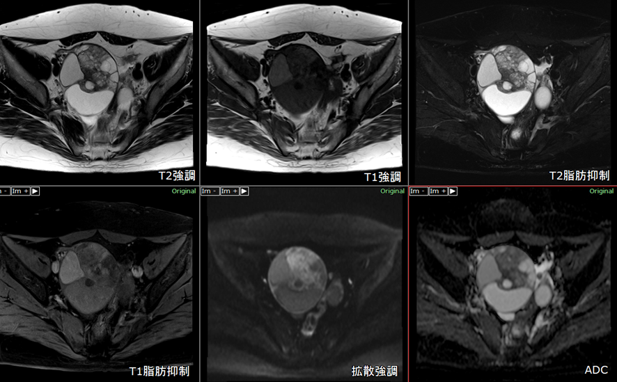 骨盤MRI-卵巣癌