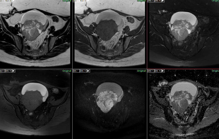 骨盤MRI-右卵巣癌