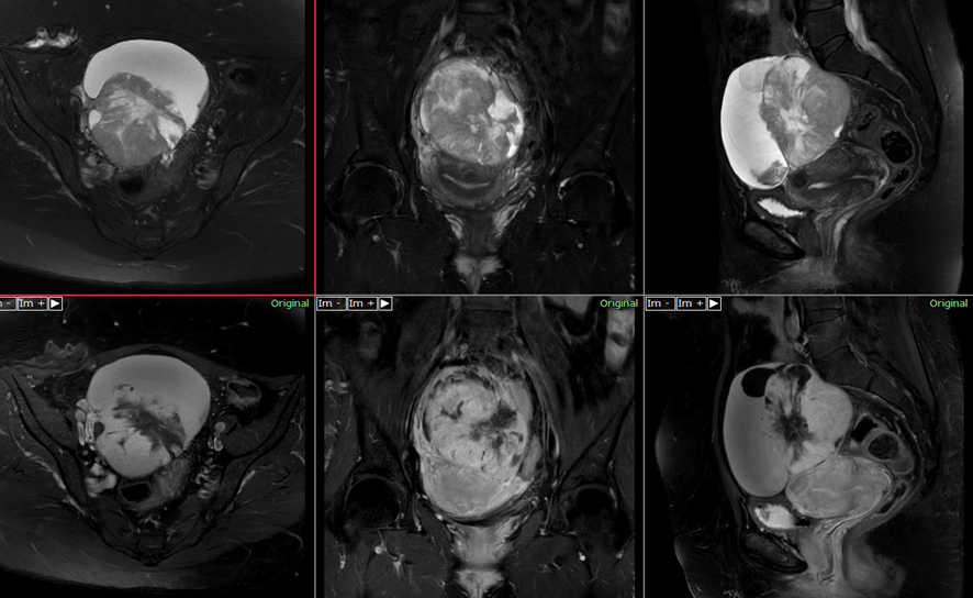 骨盤MRI-右卵巣癌