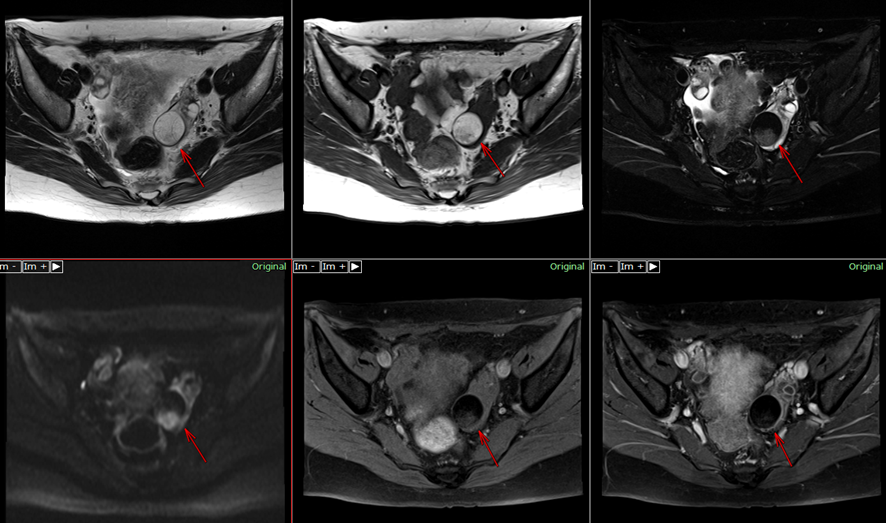 骨盤MRI-成熟奇形腫