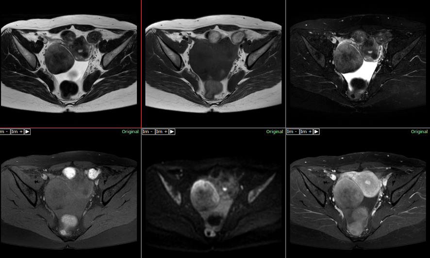 骨盤MRI-卵巣線維腫