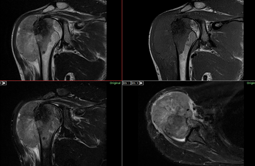 肩MRI-骨肉腫