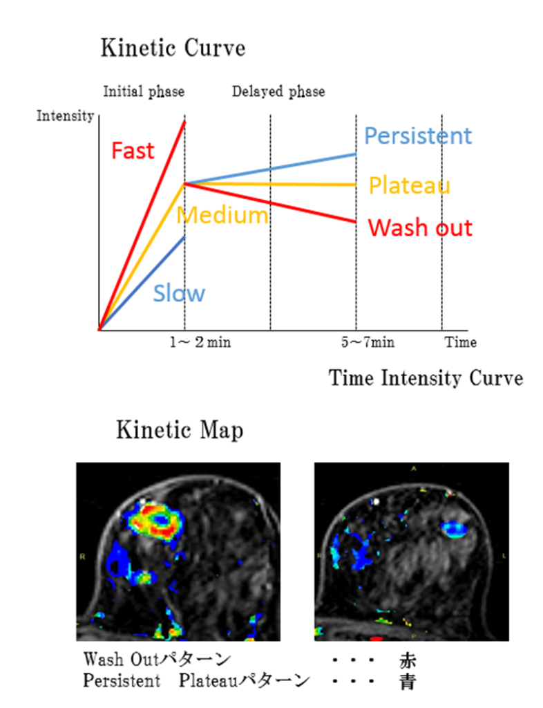 乳房MRI-悪性パターン