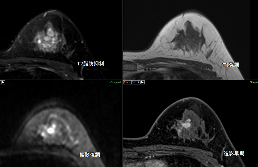 乳房MRI-乳癌