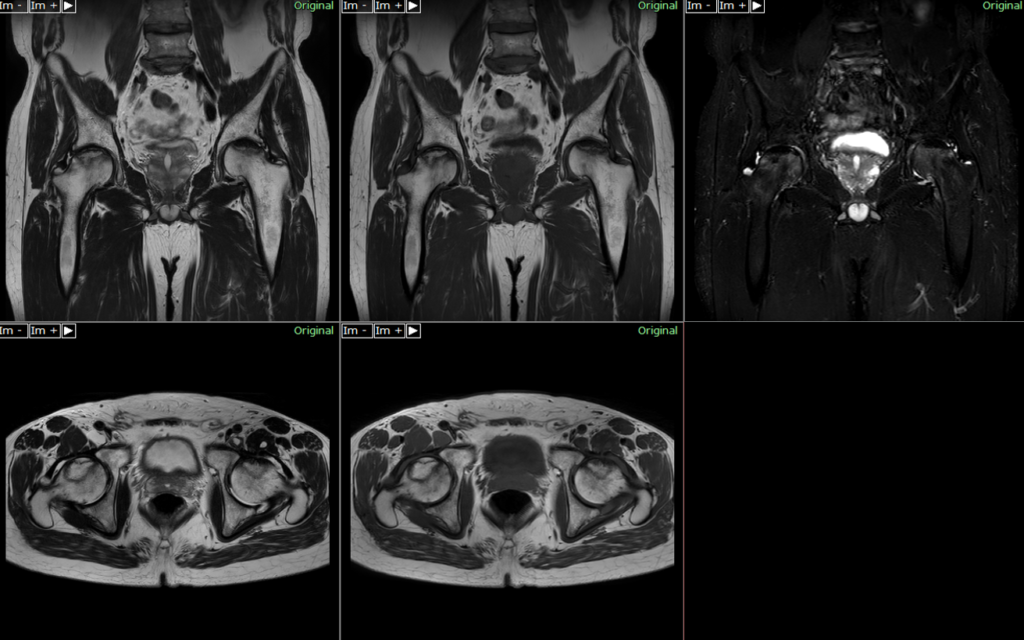 股関節MRI-大腿骨頭壊死