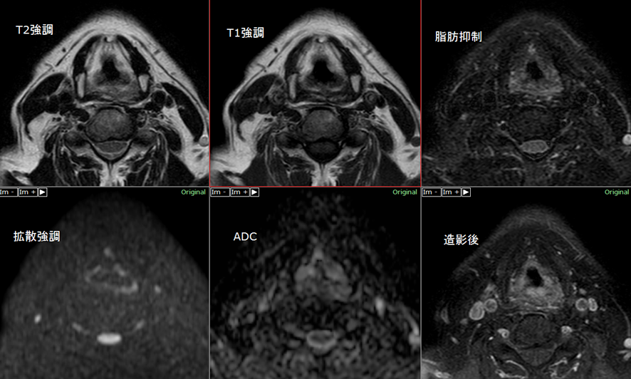 頸部MRI-下咽頭癌