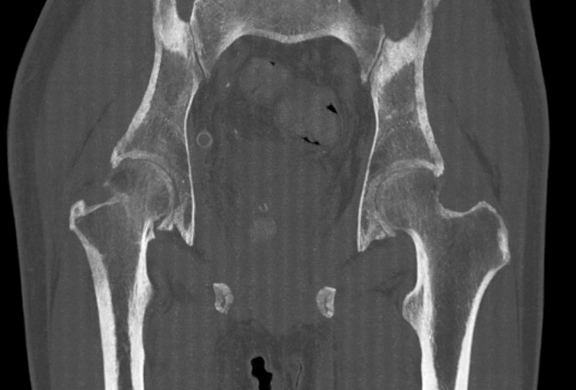 股関節CT-大腿骨頸部骨折