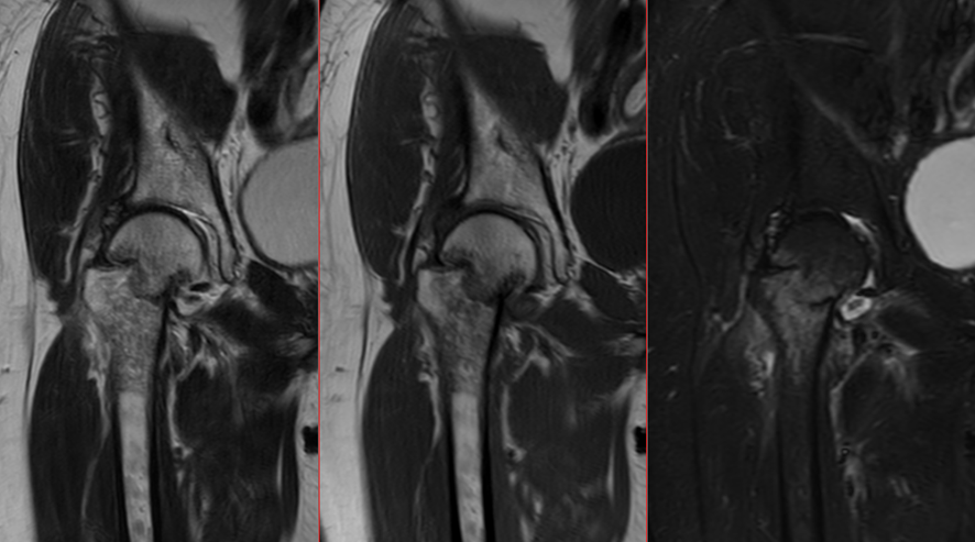 股関節MRI-大腿骨頸部骨折
