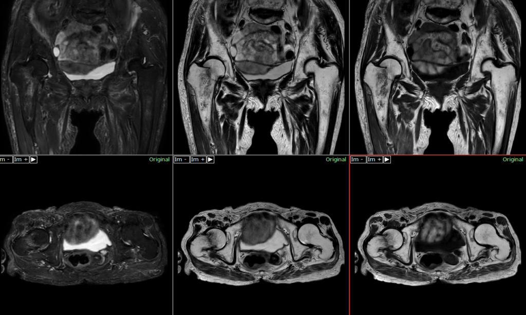 股関節MRI-大腿骨頸部骨折（Garden分類3）