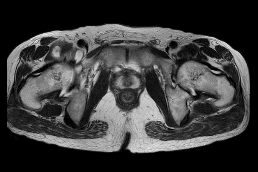 骨盤MRI-腸恥滑液包炎