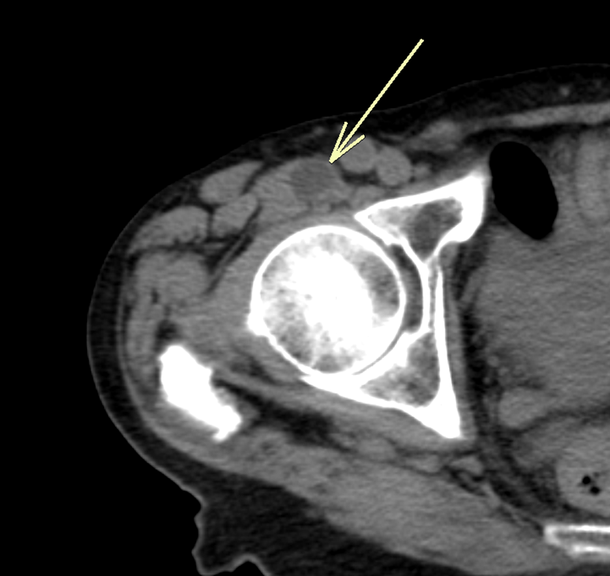 骨盤MRI-腸恥滑液包炎